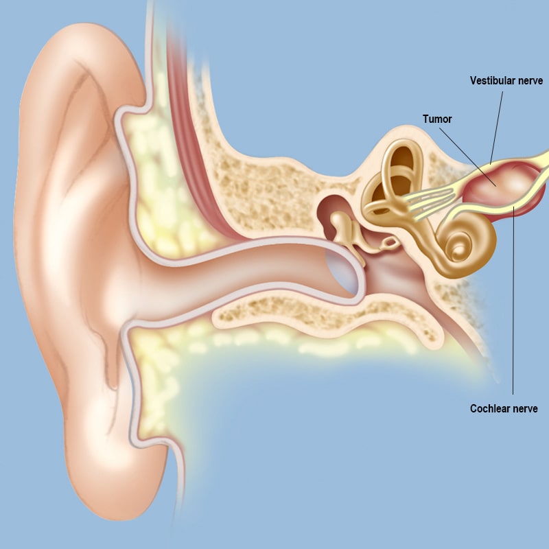 Degenerative Disc Disease Treatment