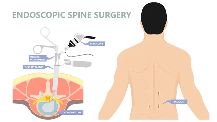 Endoscopic Spine Surgery in Delhi