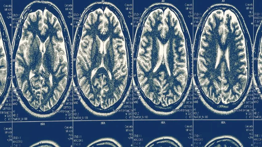 Endoscopic Treatment of Hydrocephalus in Delhi