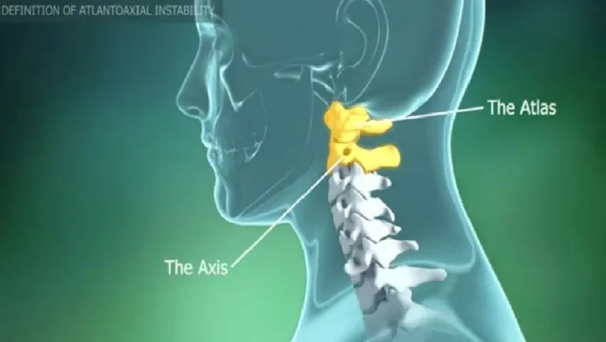 Atlanto Axial Dislocations in Delhi
