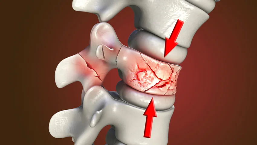 Spinal Fractures in Delhi