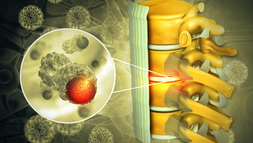 Endoscopic Removal of Spinal Tumors in Delhi
